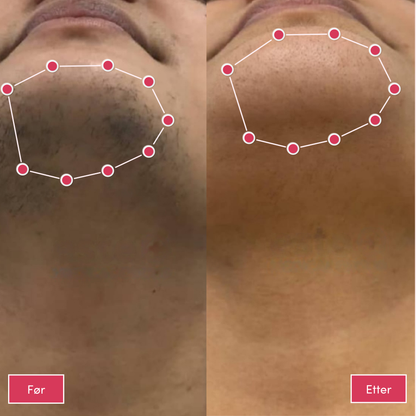 Minha loja® IPL-laser