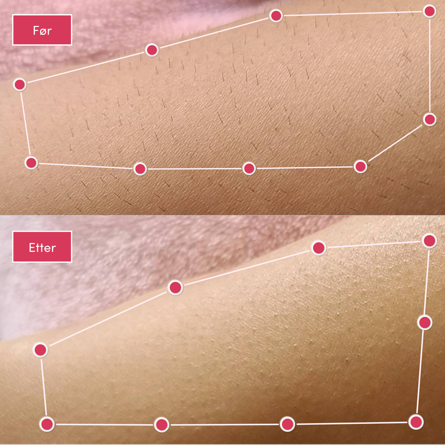 Minha loja® IPL-laser