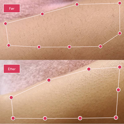 Minha loja® IPL-laser